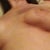 7Months post op, closer image