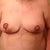 Day 2 post op
