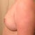 day 2 post op