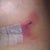 Day 2: Lt breast bruising (gotten worse from the Hanes sports bra band caving in... ouch!!!).. what is that white thing inside the steri strip???
