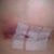 Day 2: Rt breast bruising in (also feels like gotten worse from the Hanes sports bra band)