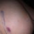 Day 2: Bruise in the mid lat of the Lt breast - still same from yesterday