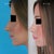 Profile Progression - Before vs. Day 84
