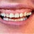 Teeth before crown lengthening/gum lift surgery and 6 upper veneers. Quite a difference.