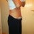 8 days post op side view