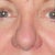 No change after rhinoplasty