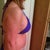 5 days post op