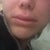 Had fat injected into my lips.  This was day of surgery. They were so puffed up and swollen!