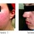 Left side view of Month 1.