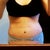 23 days post op. Still swollen but going down after losing 5 pounds.