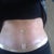 A little swollen in this picture. Using ScarAway silicon strips. I cut them in half to get 3 weeks worth out of one box. Picked them up at meijer.