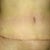 4 weeks post op (a little less swollen than 3 weeks)