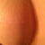 Breast lift scar 1 year post surgery