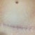 TT scar 1 year post surgery