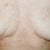 Post Explant Dec.2008.As you can see,my left breast only got worse as it began to settle.The nipple completely turned down & was painful. The right breast began puckering & indenting even more. The scars under the nipples never did heal well. Big  indented red scars.