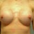 5 weeks post op