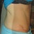 37 days po (the scar is high)