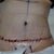 1 day post-op.  Its hard to believe this is a photo of me!
