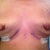 21-hrs post-removal closer up.