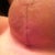 Left incision