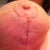 Right incision