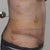 10 days PO - that weird red band going from my side incision around to the front is just from my wrap/garmet thingie