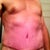 Post Op Week 3