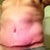 Post Op Week 3