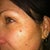 The morning after my first treatment.  You can see how the spots got much darker.