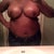 5 days post op