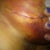 Incisions
