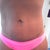 Scar 9 1/2 weeks kenalog injections given today to help flatten more suggest wearing silicone sheets