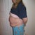 BEFORE SMART LIPO