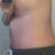 Side view 2 weeks PO