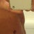 Two days post surgery. Abdominal definition clearly visible.