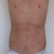Three days post surgery.