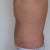 Three days post surgery.