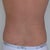 Love handles/flanks three days post surgery.