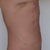 Three days post surgery.