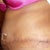 11days PO side view