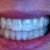 Bite (aligners) 3/4 way through