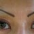 6 months post op, 2 weeks after lasering upper lid skin to tighten