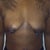 pre-op front pic