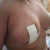 Day 1 Post Op