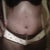 10 days since surgery and loving my results so far
