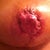 Almost 1 month post-op.  Close up of right nipple/areola after necrotic tissue removal one week ago.  PS says it is healing "nicely".