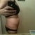 Day before surgery, profile: ready for this to be gone