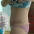 6 weeks post op tummy tuck still swollen