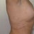 48 hours post-surgery