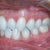 Shows my crossbite.